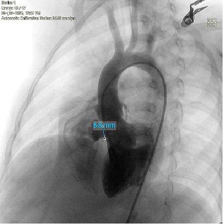 MemoSorb Biodegradable VSD Repair: Safeguarding Growth in Anatomical Complexity